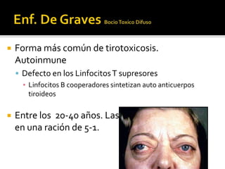  Forma más común de tirotoxicosis.
Autoinmune
 Defecto en los LinfocitosT supresores
▪ Linfocitos B cooperadores sintetizan auto anticuerpos
tiroideos
 Entre los 20-40 años. Las mujeres y hombres
en una ración de 5-1.
 