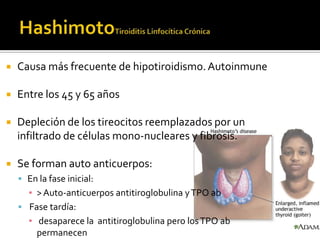  Causa más frecuente de hipotiroidismo.Autoinmune
 Entre los 45 y 65 años
 Depleción de los tireocitos reemplazados por un
infiltrado de células mono-nucleares y fibrosis.
 Se forman auto anticuerpos:
 En la fase inicial:
▪ >Auto-anticuerpos antitiroglobulina yTPO ab
 Fase tardía:
▪ desaparece la antitiroglobulina pero losTPO ab
permanecen
 