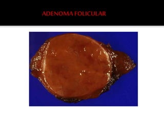 ADENOMA FOLICULAR
 