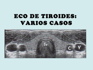 ECO DE TIROIDES:
VARIOS CASOS
 