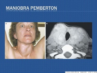 MANIOBRA PEMBERTON
 
