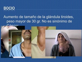 BOCIO
Aumento de tamaño de la glándula tiroides,
peso mayor de 30 gr. No es sinónimo de
Cáncer.
 