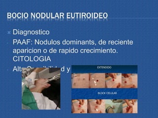 BOCIO NODULAR EUTIROIDEO
 Diagnostico
- PAAF: Nodulos dominants, de reciente
aparicion o de rapido crecimiento.
CITOLOGIA
- Alta Sensibilidad y especificidad.
 
