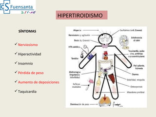 HIPERTIROIDISMO
SÍNTOMAS
Nerviosismo
Hiperactividad
Insomnio
Pérdida de peso
Aumento de deposiciones
Taquicardia