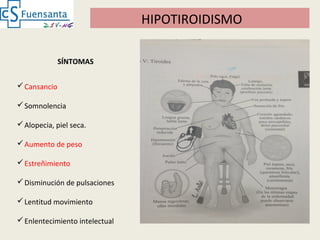 HIPOTIROIDISMO
Cansancio
Somnolencia
Alopecia, piel seca.
Aumento de peso
Estreñimiento
Disminución de pulsaciones
Lentitud movimiento
Enlentecimiento intelectual
SÍNTOMAS