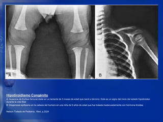 Hipotiroidismo Congénito
A: Ausencia de Epífisis femoral distal en un lactante de 3 meses de edad que nació a término. Est...