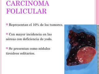 CARCINOMA
FOLICULAR
 Representan el 10% de los tumores.
 Con mayor incidencia en las
aéreas con deficiencia de yodo.
 Se presentan como nódulos
tiroideos solitarios.
 