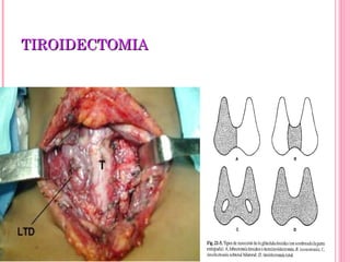 TIROIDECTOMIATIROIDECTOMIA
 