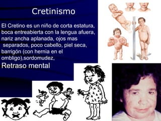 Dra. CARMEN Z. MOLINA V. 2010
Cretinismo
El Cretino es un niño de corta estatura,
boca entreabierta con la lengua afuera,
nariz ancha aplanada, ojos mas
separados, poco cabello, piel seca,
barrigón (con hernia en el
ombligo),sordomudez,
Retraso mental
 
