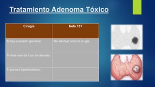 Tratamiento Adenoma Tóxico
Cirugía Iodo 131
Si hay supresión glandular. Tan efectivo como la cirugía.
Si mide mas de 3 cm de diámetro.
Si provoca hipertiroidismo.
 