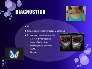 DIAGNOSTICOHCExploracionfisica: tiroides y gangliosExamenescomplementariosT3, T4, tiroglobulinaEcografiatiroidesGammagrafiatiroidesPAAFBiopsia
