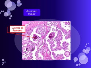 Carcinoma PapilarCuerpos de Psamoma