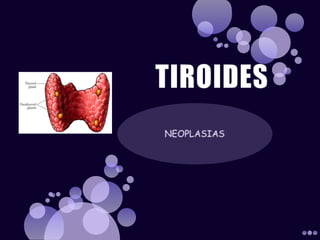TIROIDES NEOPLASIAS 