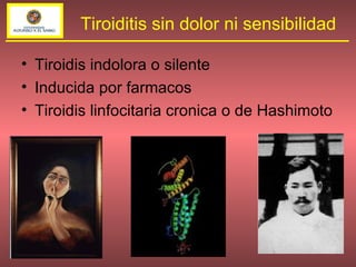 Tiroidis indolora o silente Inducida por farmacos Tiroidis linfocitaria cronica o de Hashimoto Tiroiditis sin dolor ni sensibilidad 