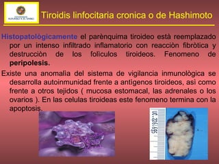 Histopatològicamente  el parènquima tiroideo està reemplazado por un intenso infiltrado inflamatorio con reacciòn fibròtica y destrucciòn de los folìculos tiroideos. Fenomeno de  peripolesis. Existe una anomalìa del sistema de vigilancia inmunològica se desarrolla autoinmunidad frente a antìgenos tiroideos, asì como frente a otros tejidos ( mucosa estomacal, las adrenales o los ovarios ). En las celulas tiroideas este fenomeno termina con la apoptosis. Tiroidis linfocitaria cronica o de Hashimoto 