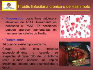 Diagnostico:  bocio firme indoloro y elevaciòn de AbAT. Raramente es necesario el PAAF. En ocasiones pueden aparecer aumentadas en numeros las células de Hurtle. Tiroidis linfocitaria cronica o de Hashimoto Tratamiento:   T4 cuando existe hipotiroidismo. Cirugìa sòlo està indicada excepcionalmente y cuando se sospecha el desarrollo de un linfoma (esto cuando aparece un ràpido creciminto tiroideo junto a sensibilidad y dolor). 