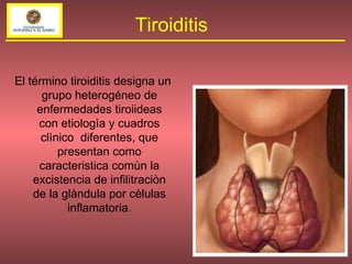 El término tiroiditis designa un grupo heterogéneo de enfermedades tiroiideas con etiologìa y cuadros clìnico  diferentes, que presentan como caracteristica comùn la excistencia de infilitraciòn de la glàndula por cèlulas inflamatoria. Tiroiditis 