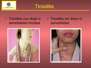 Tiroiditis con dolor o sensibilidad tiroidea Tiroiditis sin dolor ni sensibilidad Tiroiditis 