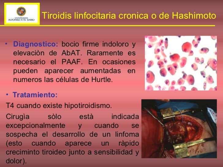 Tiroiditis