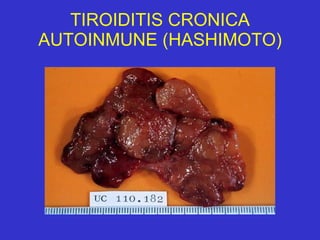 TIROIDITIS CRONICA AUTOINMUNE (HASHIMOTO) 