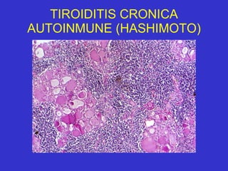 TIROIDITIS CRONICA AUTOINMUNE (HASHIMOTO) 