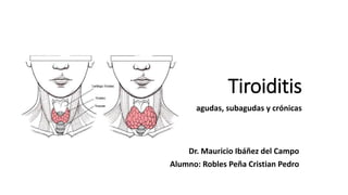 Tiroiditis
agudas, subagudas y crónicas
Dr. Mauricio Ibáñez del Campo
Alumno: Robles Peña Cristian Pedro
 