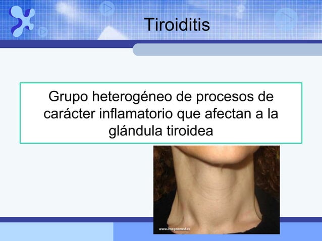 Tiroiditis Tiroiditis. Patologías inflamatorias de la Glándula Tiroides.ppt