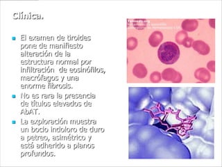 Clínica.

   El examen de tiroides
    pone de manifiesto
    alteración de la
    estructura normal por
    infiltración de eosinófilos,
    macrófagos y una
    enorme fibrosis.
   No es rara la presencia
    de títulos elevados de
    AbAT.
   La exploración muestra
    un bocio indoloro de duro
    a petreo, asimétrico y
    está adherido a planos
    profundos.
 