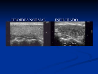 TIROIDES NORMAL INFILTRADO  PUNTIFORME 