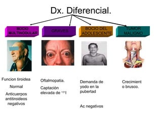 Dx. Diferencial. BOCIO  MULTINODULAR GRAVES BOCIO DEL  ADOLESCENTE TUMOR  MALIGNO  Funcion tiroidea  Normal Anticuerpos antitiroideos negativos Oftalmopatia. Captación elevada de  131 I Demanda de yodo en la pubertad Ac negativos Crecimiento brusco. 