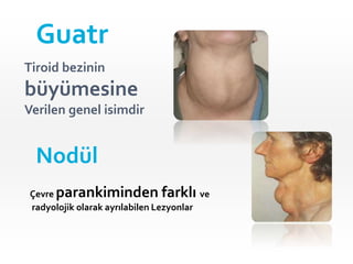 Tiroid bezinin
büyümesine
Verilen genel isimdir
Guatr
Nodül
Çevre parankiminden farklı ve
radyolojik olarak ayrılabilen Lezyonlar
 