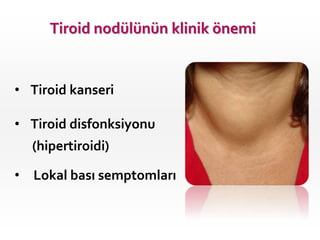 • Tiroid kanseri
• Tiroid disfonksiyonu
(hipertiroidi)
• Lokal bası semptomları
Tiroid nodülünün klinik önemi
 
