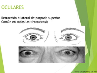 OCULARES
Retracción bilateral de parpado superior
Común en todas las tirotoxicosis
Neurol Clin 28 (2010) 729–755.
 