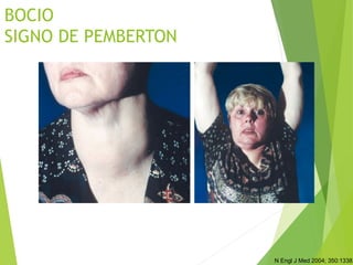 BOCIO
SIGNO DE PEMBERTON
N Engl J Med 2004; 350:1338.
 