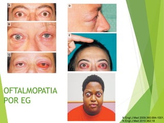 N Engl J Med 2009;360:994-1001.
N Engl J Med 2010;362;18
OFTALMOPATIA
POR EG
 