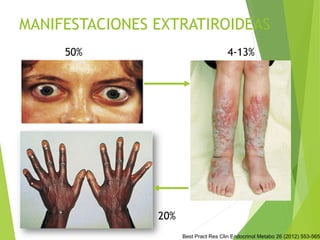 Best Pract Res Clin Endocrinol Metabo 26 (2012) 553-565.
MANIFESTACIONES EXTRATIROIDEAS
50% 4-13%
20%
 