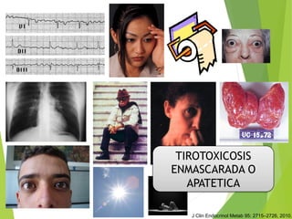 TIROTOXICOSIS
ENMASCARADA O
APATETICA
J Clin Endocrinol Metab 95: 2715–2726, 2010.
 