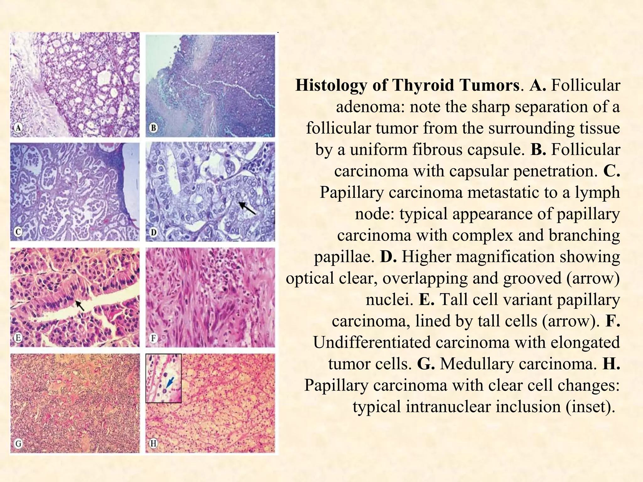 Histology of Thyroid Tumors. A. Follicular
adenoma: note the sharp separation of a
follicular tumor from the surrounding tissue
by a uniform fibrous capsule. B. Follicular
carcinoma with capsular penetration. C.
Papillary carcinoma metastatic to a lymph
node: typical appearance of papillary
carcinoma with complex and branching
papillae. D. Higher magnification showing
optical clear, overlapping and grooved (arrow)
nuclei. E. Tall cell variant papillary
carcinoma, lined by tall cells (arrow). F.
Undifferentiated carcinoma with elongated
tumor cells. G. Medullary carcinoma. H.
Papillary carcinoma with clear cell changes:
typical intranuclear inclusion (inset).
 