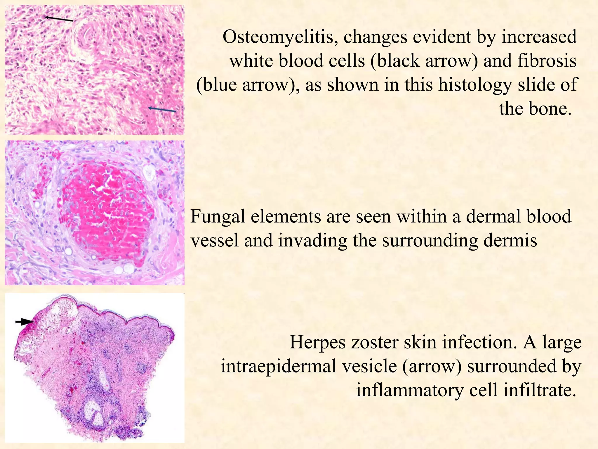 Osteomyelitis, changes evident by increased
white blood cells (black arrow) and fibrosis
(blue arrow), as shown in this histology slide of
the bone.
Fungal elements are seen within a dermal blood
vessel and invading the surrounding dermis
Herpes zoster skin infection. A large
intraepidermal vesicle (arrow) surrounded by
inflammatory cell infiltrate.
 