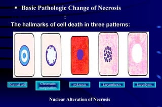 Nucleus changes : The hallmarks of cell death in three patterns: Basic Pathologic Change of Necrosis Normal cell Chromatin margination karyorrhexis pyknosis karyolysis Nuclear Alteration of Necrosis 