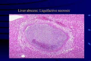 Liver abscess: Liquifactive necrosis 