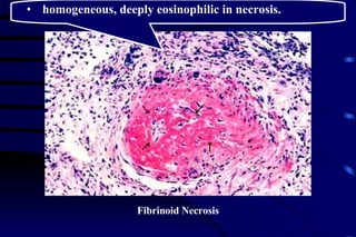 Fibrinoid Necrosis homogeneous, deeply eosinophilic in necrosis. 