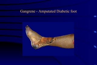 Gangrene - Amputated Diabetic foot 