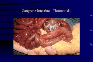 Gangrene Intestine - Thrombosis. 