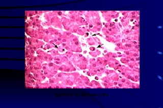 Apotosis of hepatocytes 