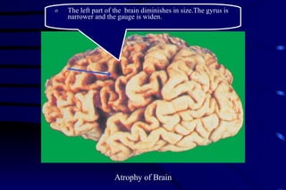 Atrophy of Brain The left part of the  brain diminishes in size.The gyrus is narrower and the gauge is widen. 