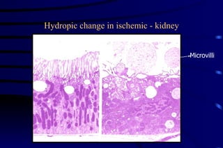 Hydropic change in ischemic - kidney Microvilli 