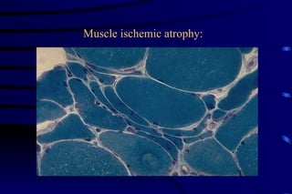 Muscle ischemic atrophy: 