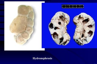 Hydronephrosis 