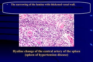 Hyaline change of the central artery of the spleen (spleen of hypertension disease) The narrowing of the lumina with thickened vessel wall.  Homogeneous pink hyaline material deposits under the intima. 